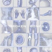 broken bones